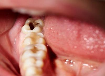 دانستنی هایی درباره پوسیدگی دندان