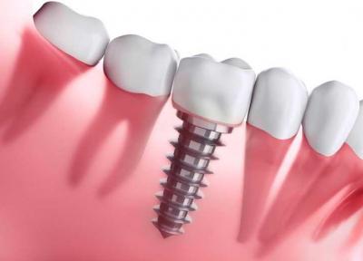 بعد از انجام عمل جراحی ایمپلنت چگونه از جایگزین دندان هایمان به درستی حفاظت کنیم؟