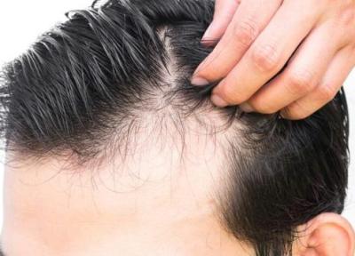 مکمل بیوتین در جلوگیری از ریزش مو موثر است؟